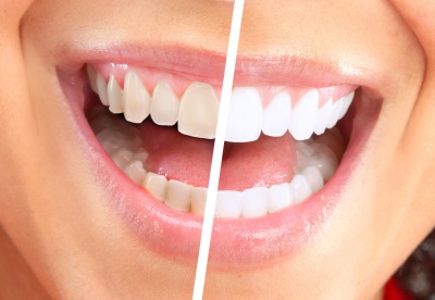 Отбеливание зубов. Как отбелить зубы в домашних условиях, и стоит ли это делать?