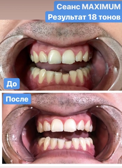 Можно ли отбеливать металлокерамические зубы? Способы и рекомендации