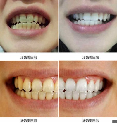 Как и чем отбелить зубные протезы?